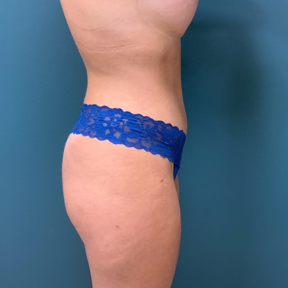 Mommy Makeover Before & After Patient #484