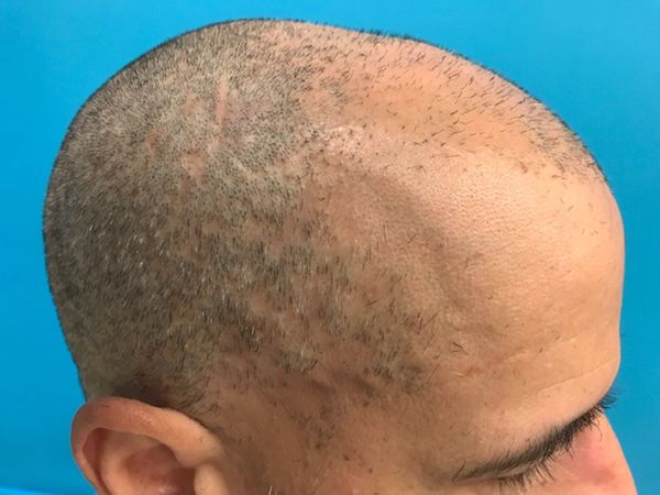 NeoGraft Before & After Patient #597