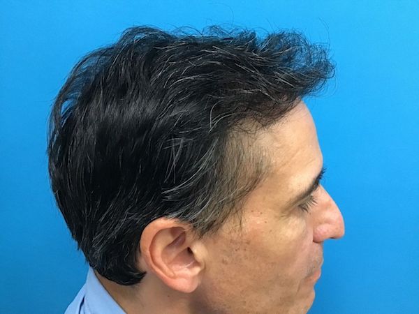 NeoGraft Before & After Patient #597