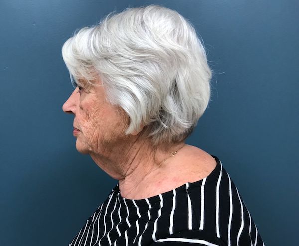 Neck Lift Before & After Patient #546