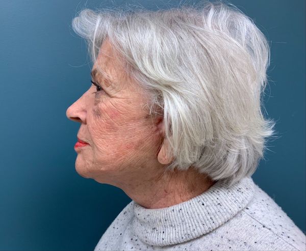 Neck Lift Before & After Patient #546