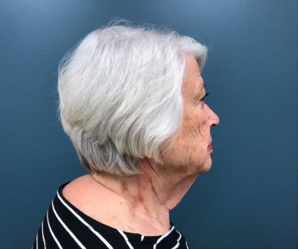 Neck Lift Before & After Patient #546