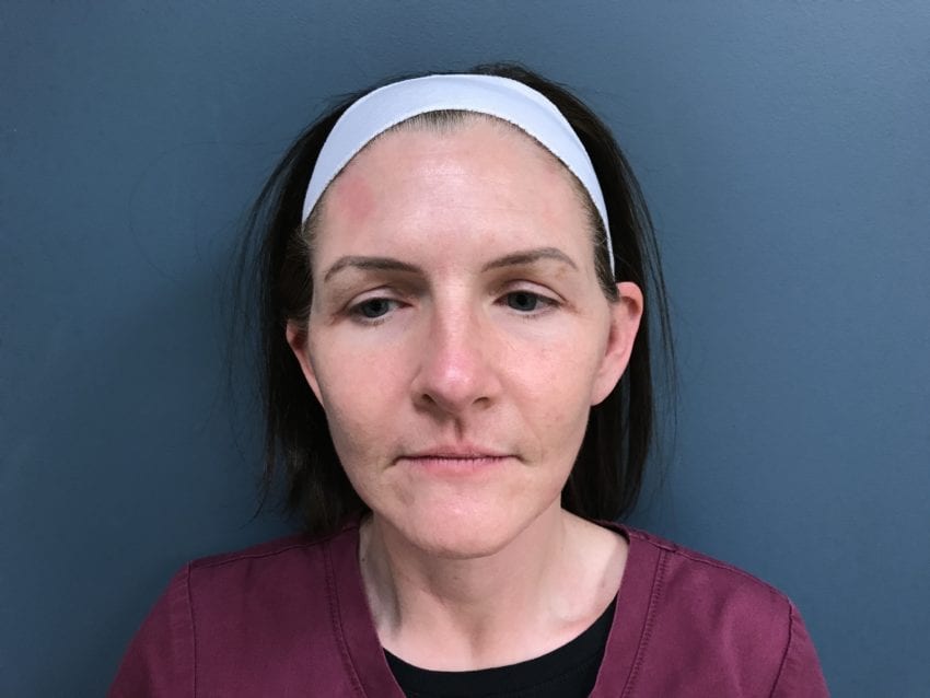 Facelift Before & After Patient #494
