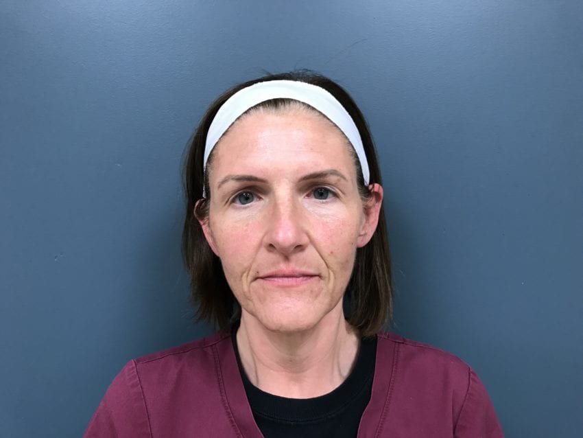 Facelift Before & After Patient #494