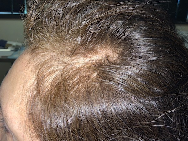 PRP Before & After Patient #602