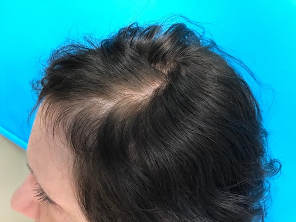 PRP Before & After Patient #602