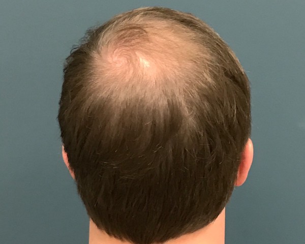 PRP Before & After Patient #607