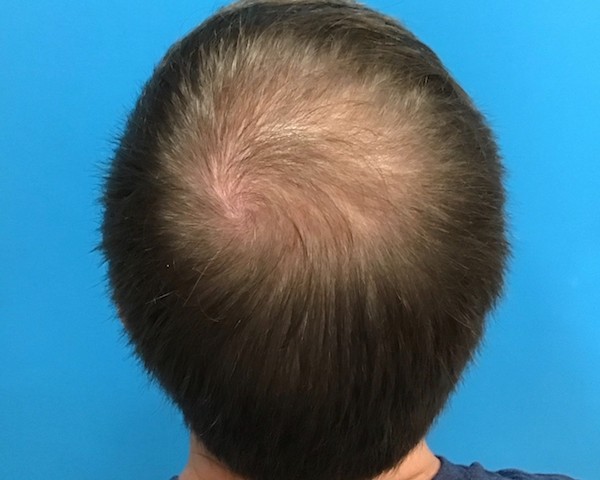 PRP Before & After Patient #607