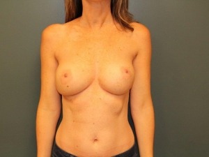 Breast Reconstruction Before & After Patient #374