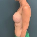 Breast Reconstruction Before & After Patient #374