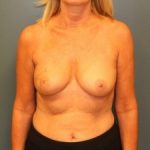 Breast Reconstruction Before & After Patient #381