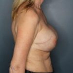 Breast Reconstruction Before & After Patient #381
