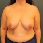 Breast Reconstruction Before & After Patient #388