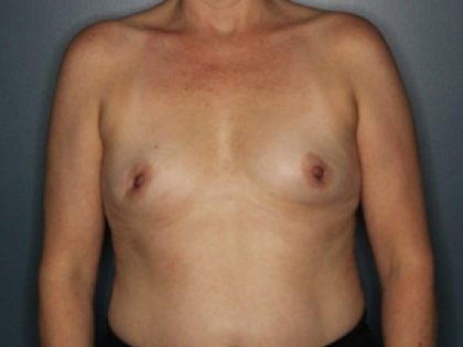 Breast Reconstruction Before & After Patient #395