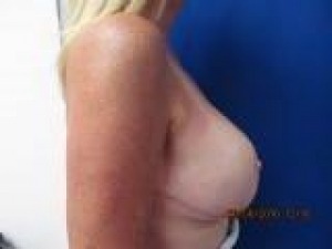 Breast Reconstruction Before & After Patient #402