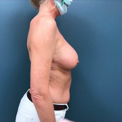 Breast Revision Before & After Patient #363