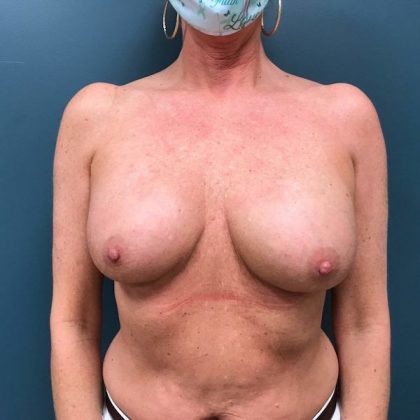 Breast Revision Before & After Patient #363