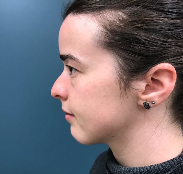 Rhinoplasty Before & After Patient #551