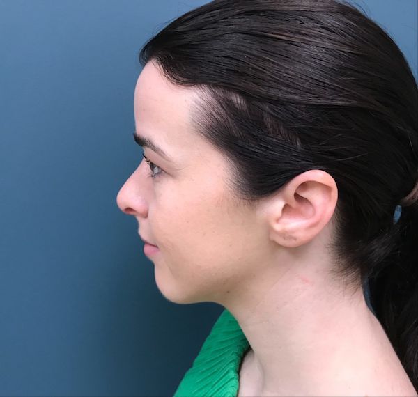 Rhinoplasty Before & After Patient #551