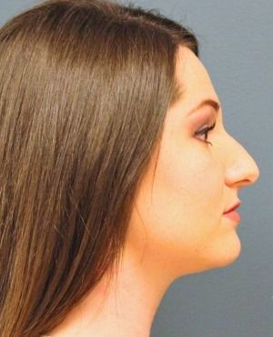 Rhinoplasty Before & After Patient #556