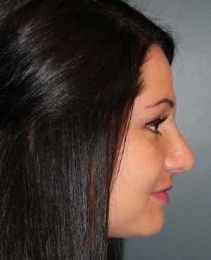 Rhinoplasty Before & After Patient #556