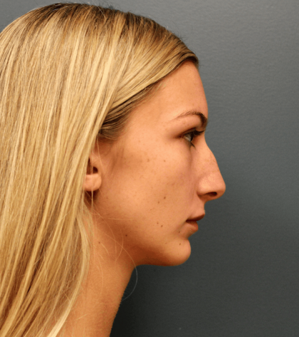 Rhinoplasty Before & After Patient #563