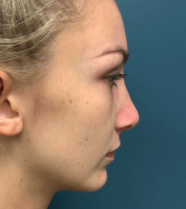 Rhinoplasty Before & After Patient #563