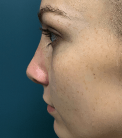 Rhinoplasty Before & After Patient #563