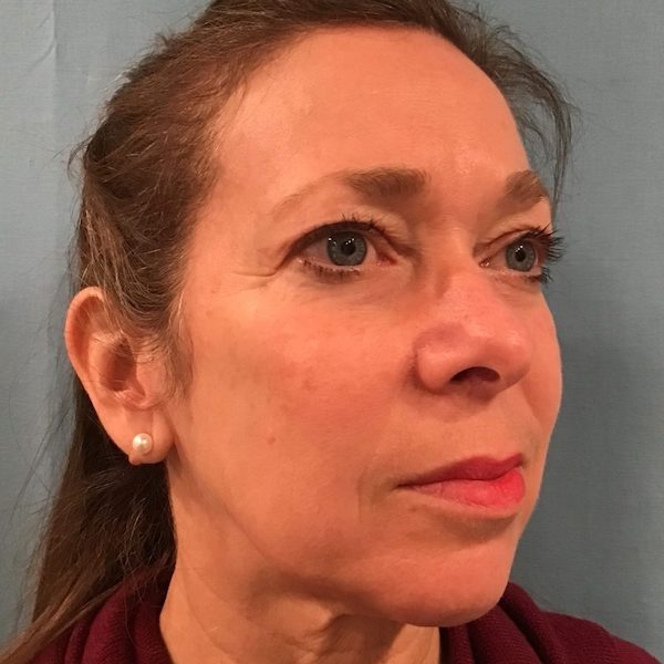 Blepharoplasty Before & After Patient #570
