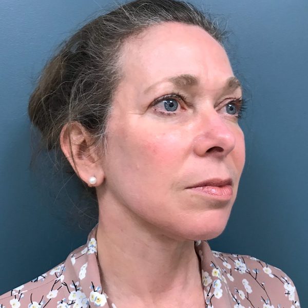 Blepharoplasty Before & After Patient #570