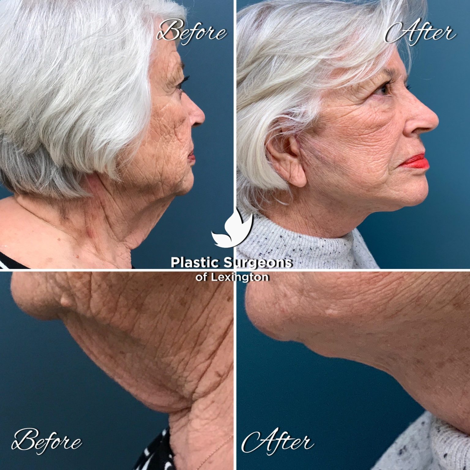 Neck Lift Lexington