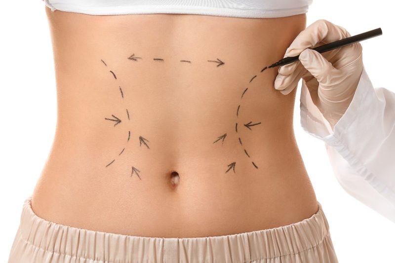 Body Contouring Procedures Lexington