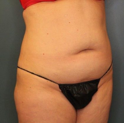 Tummy Tuck Before & After Patient #437