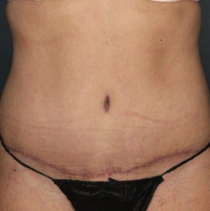 Tummy Tuck Before & After Patient #437