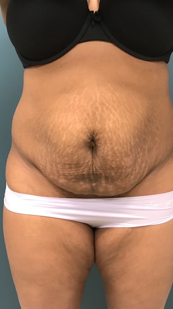 Tummy Tuck Before & After Patient #442