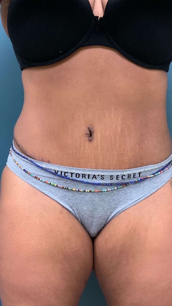 Tummy Tuck Before & After Patient #442
