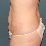 Tummy Tuck Before & After Patient #449