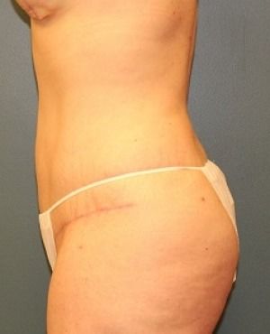 Tummy Tuck Before & After Patient #449