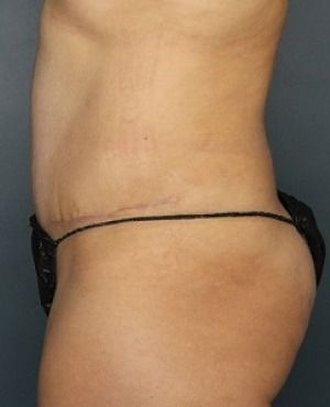 Tummy Tuck Before & After Patient #456