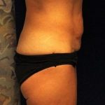 Tummy Tuck Before & After Patient #465
