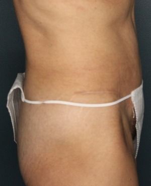 Tummy Tuck Before & After Patient #465
