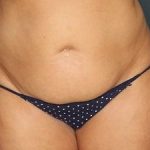 Tummy Tuck Before & After Patient #472