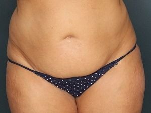 Tummy Tuck Before & After Patient #472