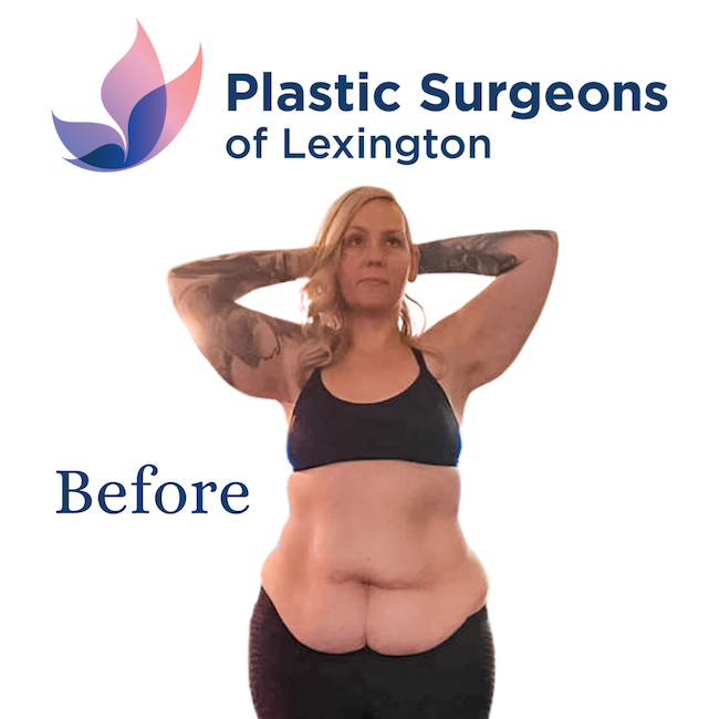 Tummy Tuck Before & After Patient #1140