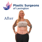 Tummy Tuck Before & After Patient #1140