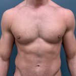 Gynecomastia Before & After Patient #1143