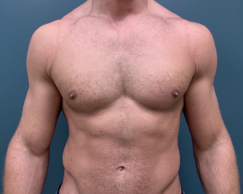 Gynecomastia Before & After Patient #1143