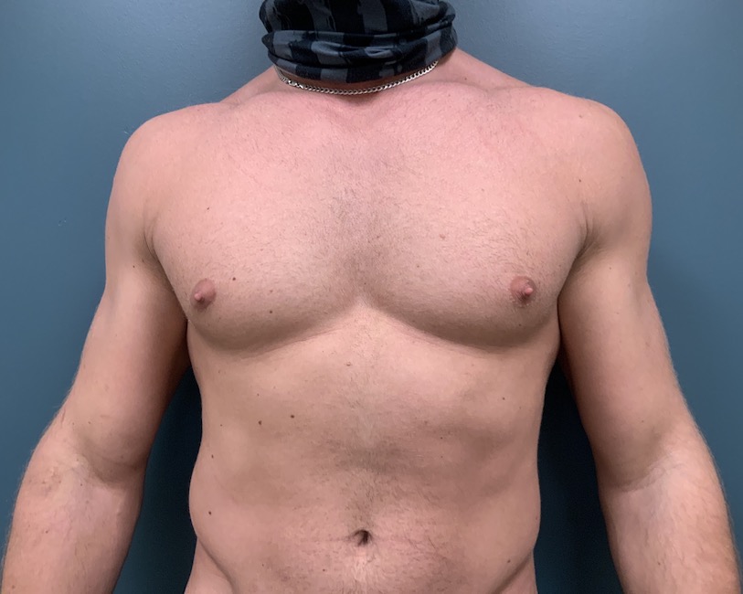 Gynecomastia Before & After Patient #1143