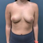 Breast Augmentation Before & After Patient #1118