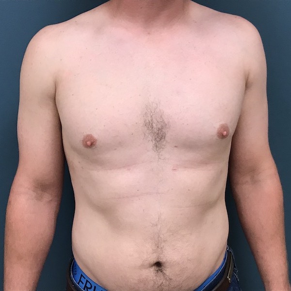 Gynecomastia Before & After Patient #1108